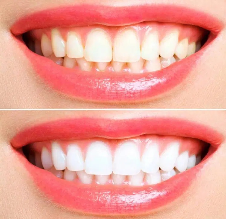 Teeth whitening Chandler