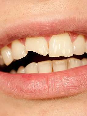 Close-up of broken front tooth showing dental damage requiring professional repair.